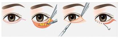 外切法祛眼袋皱纹