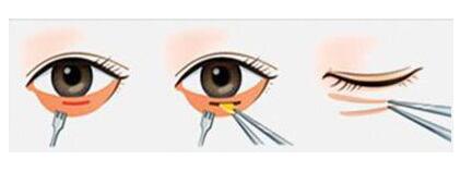 内切法祛眼袋皱纹