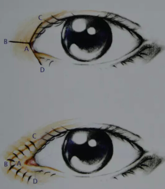 开眼角是把眼角的肉剪掉吗？