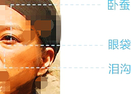 玻尿酸填充泪沟变成了眼袋怎么办