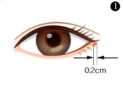 不开刀溶脂去眼袋多少钱