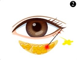 不开刀溶脂去眼袋多少钱