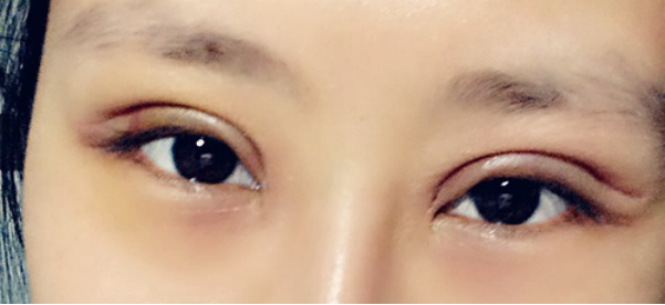 妹子分享切开双眼皮消肿妙招：敷土豆片！