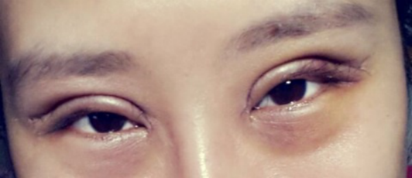 妹子分享切开双眼皮消肿妙招：敷土豆片！