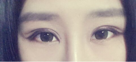 妹子分享切开双眼皮消肿妙招：敷土豆片！