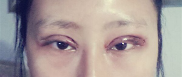 妹子分享切开双眼皮消肿妙招：敷土豆片！