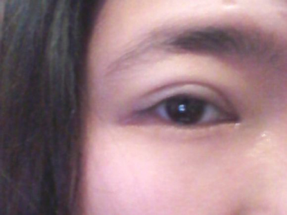 我的埋线双眼皮恢复日记 大家看看肿么样！