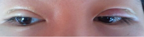 我的埋线双眼皮恢复日记 大家看看肿么样！