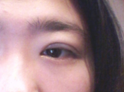 我的埋线双眼皮恢复日记 大家看看肿么样！