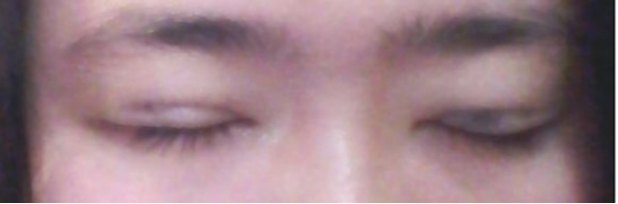 我的埋线双眼皮恢复日记 大家看看肿么样！