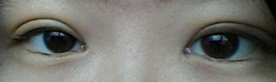 我的埋线双眼皮恢复日记 大家看看肿么样！