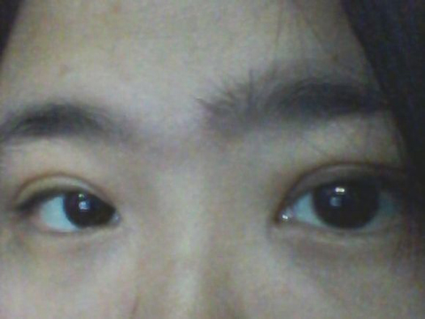 我的埋线双眼皮恢复日记 大家看看肿么样！