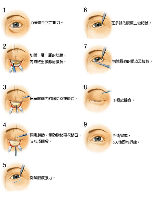 熬夜眼袋怎么消除
