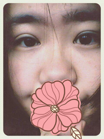 我的埋线双眼皮恢复日记 大家看看肿么样！