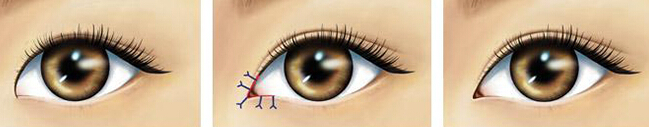爱美的亲看过来：开眼角术好吗？