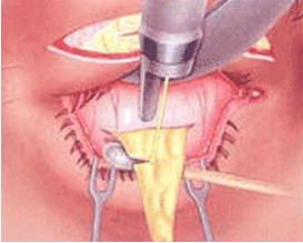 熬夜眼袋怎么消除