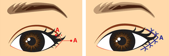 爱美的亲看过来：开眼角术好吗？