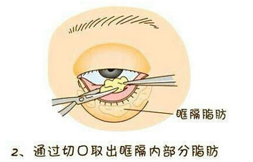 微整形去眼袋过程图