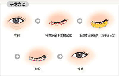 一张图了解：微整形眼袋手术过程