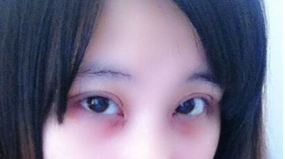 妹子分享：我做双眼皮开眼角后的恢复照 
