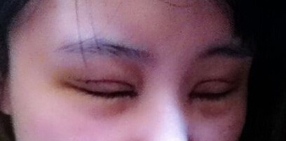 妹子分享：我做双眼皮开眼角后的恢复照 