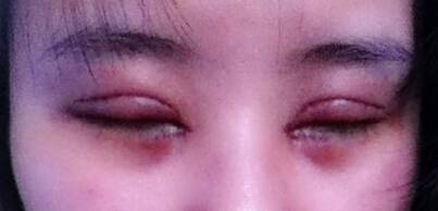 妹子分享：我做双眼皮开眼角后的恢复照 