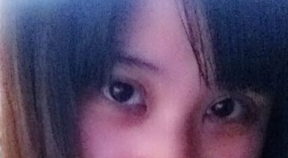 妹子分享：我做双眼皮开眼角后的恢复照 