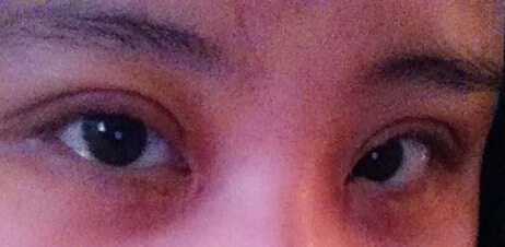 妹子分享：我做双眼皮开眼角后的恢复照 