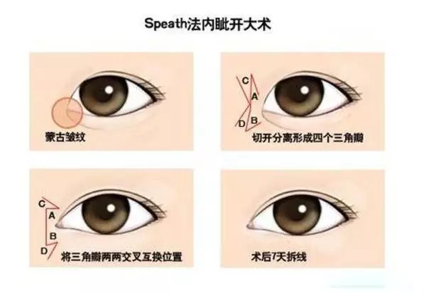开眼角是什么样子？上图告诉你