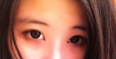 妹子分享：我做双眼皮开眼角后的恢复照 