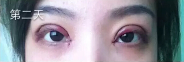 开眼角什么时候能好？来看网友实例皂片