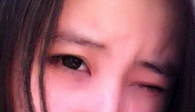 妹子分享：我做双眼皮开眼角后的恢复照 