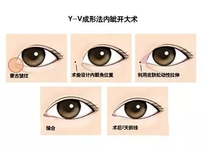 开眼角是什么样子？上图告诉你