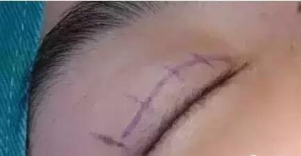 双眼皮手术埋线法是怎么做的