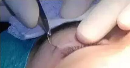 双眼皮手术埋线法是怎么做的