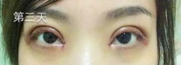 开眼角什么时候能好？来看网友实例皂片