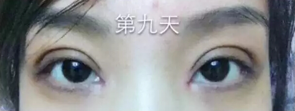 开眼角什么时候能好？来看网友实例皂片