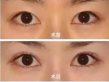 双眼皮手术埋线法是怎么做的