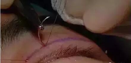 双眼皮手术埋线法是怎么做的