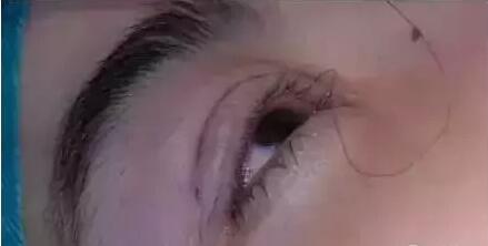 双眼皮手术埋线法是怎么做的