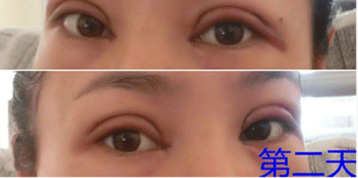 全切双眼皮加开内眼角后 我的整个气质up！