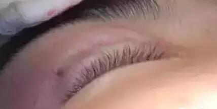 双眼皮手术埋线法是怎么做的