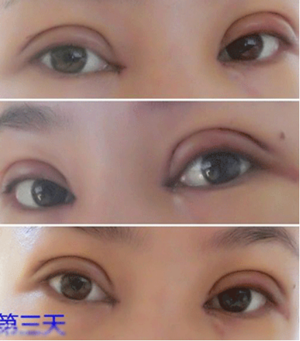 全切双眼皮加开内眼角后 我的整个气质up！