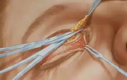 切开双眼皮手术中如何抽脂