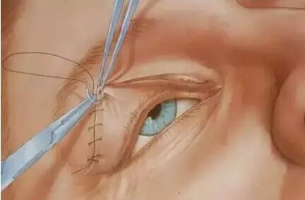 切开双眼皮手术中如何抽脂