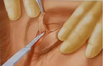 切开双眼皮手术中如何抽脂