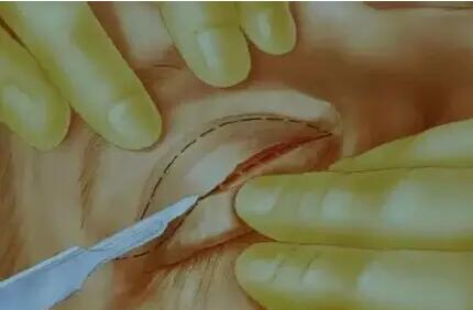 切开双眼皮手术中如何抽脂