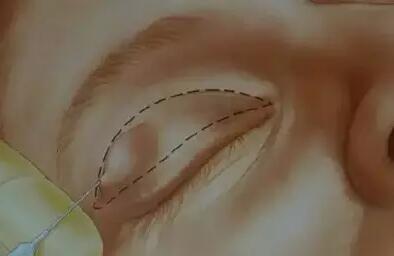 切开双眼皮手术中如何抽脂