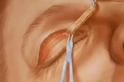 切开双眼皮手术中如何抽脂