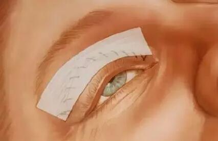 切开双眼皮手术中如何抽脂